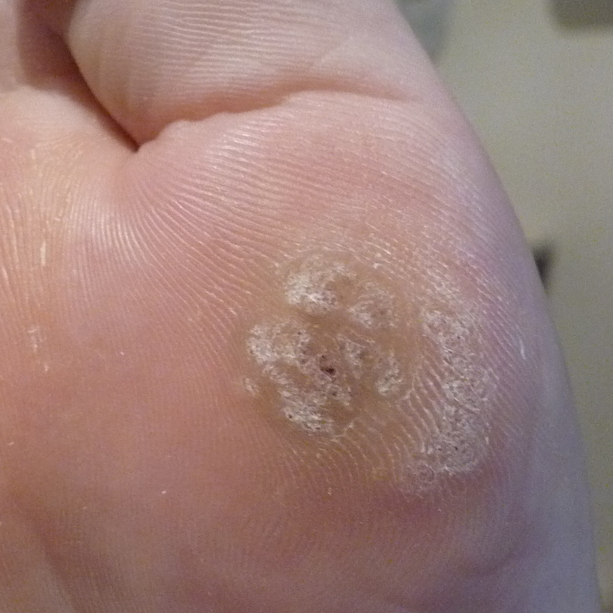 Advanced Podiatry Clinics Wart Laser Treatment